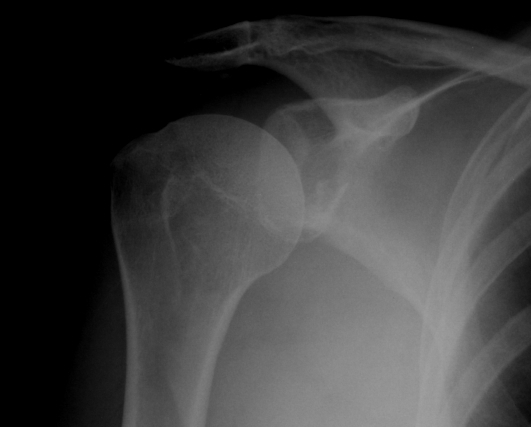 Glenoid Rim Fracture